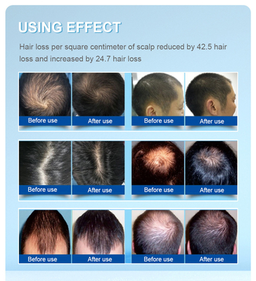 casquillo del nuevo crecimiento del laser del pelo de la tecnología de 650nm Lllt ambo en hombres y mujeres